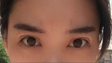 韓式開眼角的有副作用嗎？