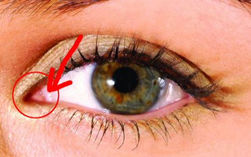 開內(nèi)眼角手術(shù)有什么效果？術(shù)后有哪些注意事項(xiàng)？
