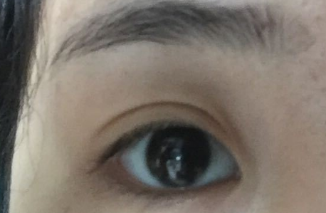 開內(nèi)眼角拆線后變化明顯嗎？開內(nèi)眼角會(huì)不會(huì)留疤？