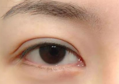 開內(nèi)外眼角多久能恢復(fù)好？開內(nèi)外眼角多少錢？