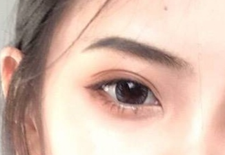 開(kāi)內(nèi)外眼角的恢復(fù)期是多久？術(shù)后后遺癥有哪些？