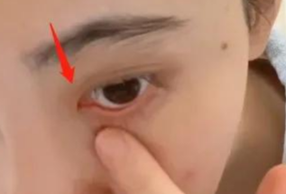 開內眼角對眼睛有傷害嗎？