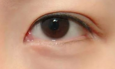 開內眼角的優(yōu)缺點有哪些？