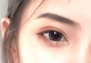 開(kāi)內(nèi)外眼角怎么消腫快？開(kāi)內(nèi)外眼角有什么壞處？