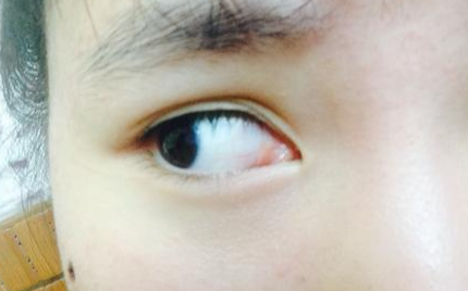 開內(nèi)眼角風(fēng)險(xiǎn)有多大？