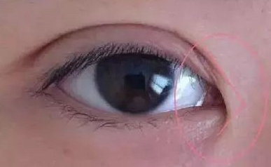 開(kāi)內(nèi)眼角的作用有哪些？開(kāi)內(nèi)眼角都會(huì)回縮嗎？