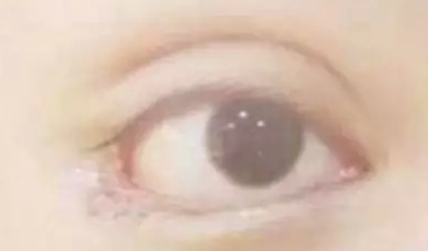 開內(nèi)眼角的效果好嗎？