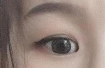 開內眼角的手術費用多少？術后禁忌癥有哪些？