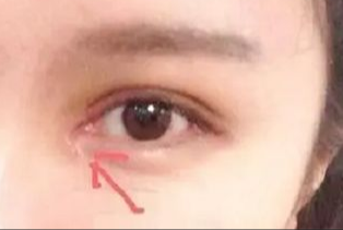 開眼角割雙眼皮拆線嗎？術(shù)后拆線疼嗎？