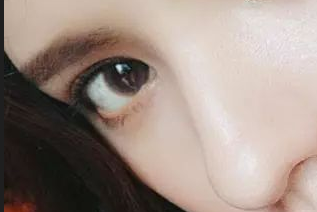 開眼角有害嗎？開眼角有疤痕嗎？