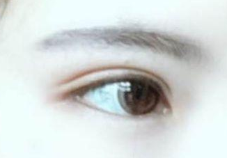 開眼角有幾種方法?開眼角有后遺癥嗎？