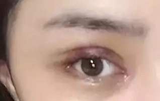 開眼角一般要恢復(fù)多久？