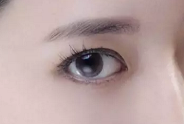 開(kāi)眼角術(shù)后多久才能恢復(fù)？開(kāi)眼角術(shù)后防止疤痕增生怎么做？