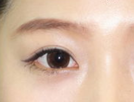 開眼角手術(shù)有哪些適應(yīng)人群呢？開眼角手術(shù)有哪些特點(diǎn)？