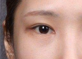 開眼角的術后護理方法有哪些？