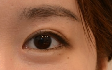 外眼角開(kāi)大了能修復(fù)嗎？