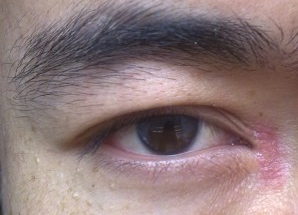 開眼角術(shù)后如何快速消腫？