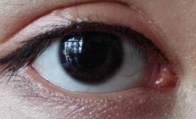 做開眼角疼不疼？做開眼角要多少錢？