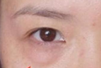 光纖溶脂去眼袋手術(shù)有哪些優(yōu)勢(shì)？