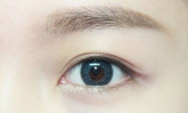 開眼角需要注意的事項有哪些？