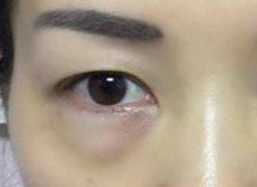 光纖溶脂去眼袋術(shù)后如何護(hù)理？