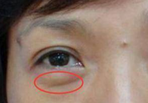 埋線去眼袋能維持多久？