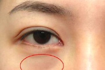 光纖溶脂祛眼袋需要多少錢？光纖溶脂怎么樣呢？