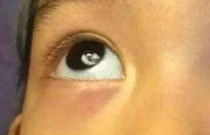激光祛眼袋需要多少錢？
