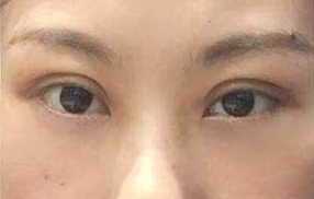 激光去眼袋能維持多長(zhǎng)時(shí)間？祛眼袋的手術(shù)效果好嗎？