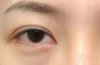 激光去眼袋多久做一次？激光去除眼袋后遺癥有哪些？