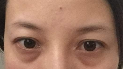 激光祛除眼袋有效嗎？激光祛眼袋有什么利弊？