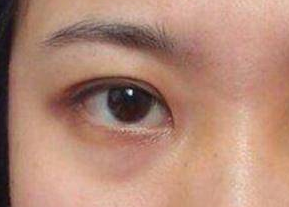 去眼袋是激光好還是內切好？激光祛眼袋是什么原理？