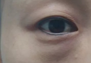 激光去眼袋可以管多久？