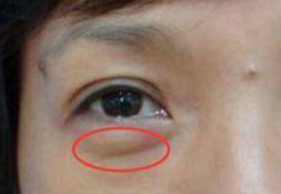 激光去眼袋可以管多久？激光祛眼袋多久可以恢復(fù)？