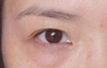 激光去除眼袋后遺癥有哪些？