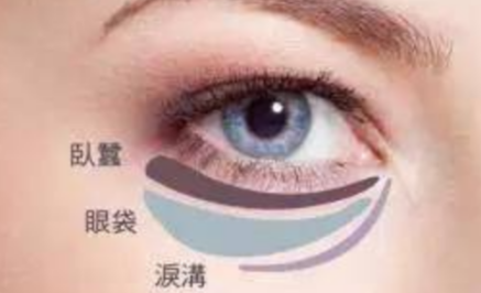 激光能祛除眼袋嗎？