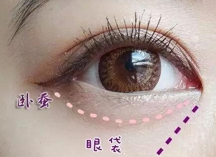 激光消除眼袋怎么樣？激光溶脂去眼袋多少錢？