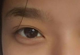 激光去眼袋后需多久能恢復？激光去眼袋快速有效嗎？