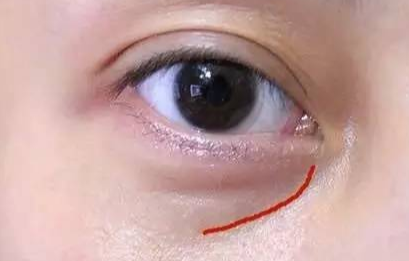 激光去眼袋手術(shù)費(fèi)用是多少？
