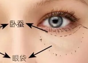 激光祛眼袋多久才能恢復(fù)？