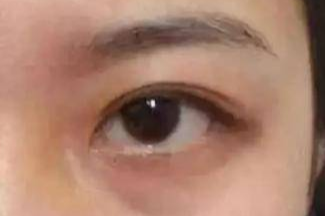 激光祛眼袋效果真的好嗎？激光去眼袋會有風險嗎？