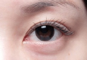 激光去眼袋會不會很疼？激光去眼袋什么人適合？