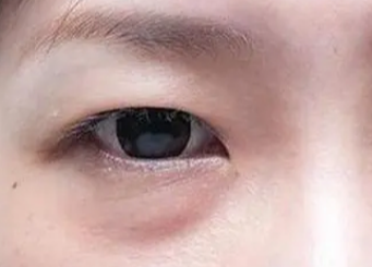 激光去眼袋要多長(zhǎng)時(shí)間？做激光去眼袋手術(shù)要多久？