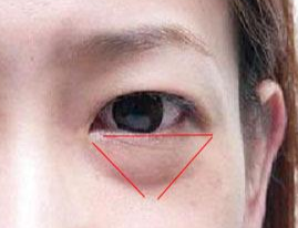 激光除眼袋效果如何？激光去眼袋要注意什么？