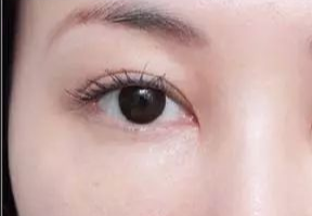 激光去眼袋什么人適合？