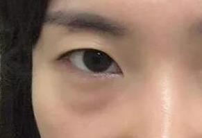 激光祛眼袋會(huì)疼嗎？激光去眼袋手術(shù)好嗎？