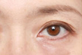 激光去眼袋幾天能恢復(fù)？激光去眼袋是怎樣的？