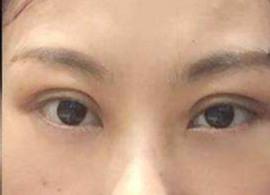 激光去眼袋可保持多久？激光去除眼袋效果好不好？
