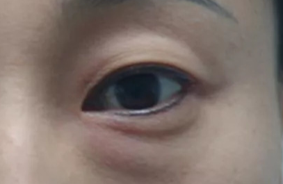 激光去除眼袋效果好不好？