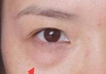 激光去眼袋的效果怎么樣？激光去眼袋注意事項有哪些？